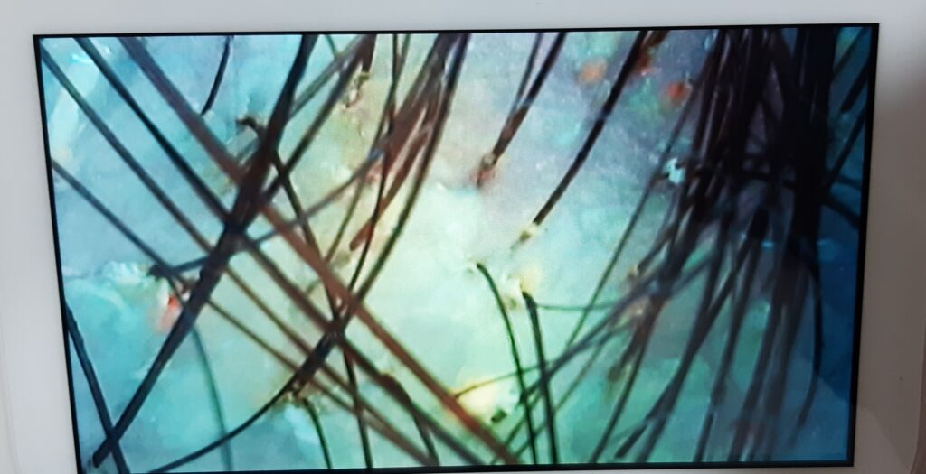 Problème du cuir chevelu observé à la caméra microscopique, photographie 6