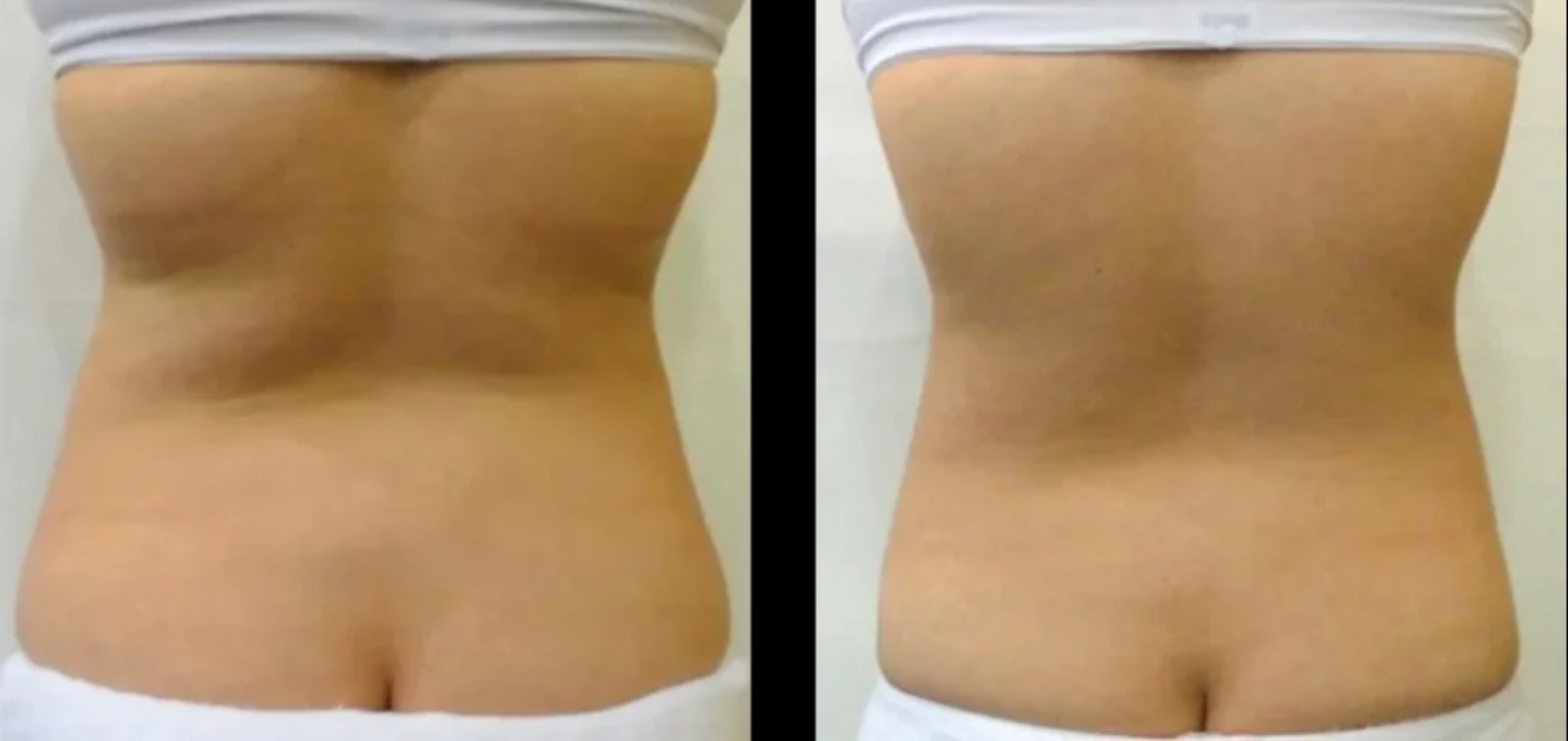 Comparaison illustrative fournie montrant l’apparence de l’abdomen